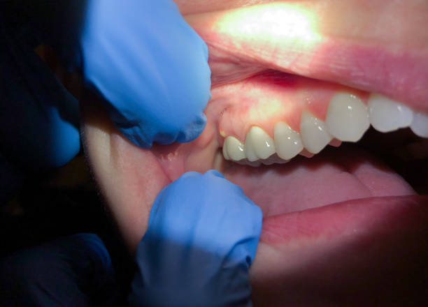 Best Emergency Dentist for Knocked-Out Tooth in Powell, OH